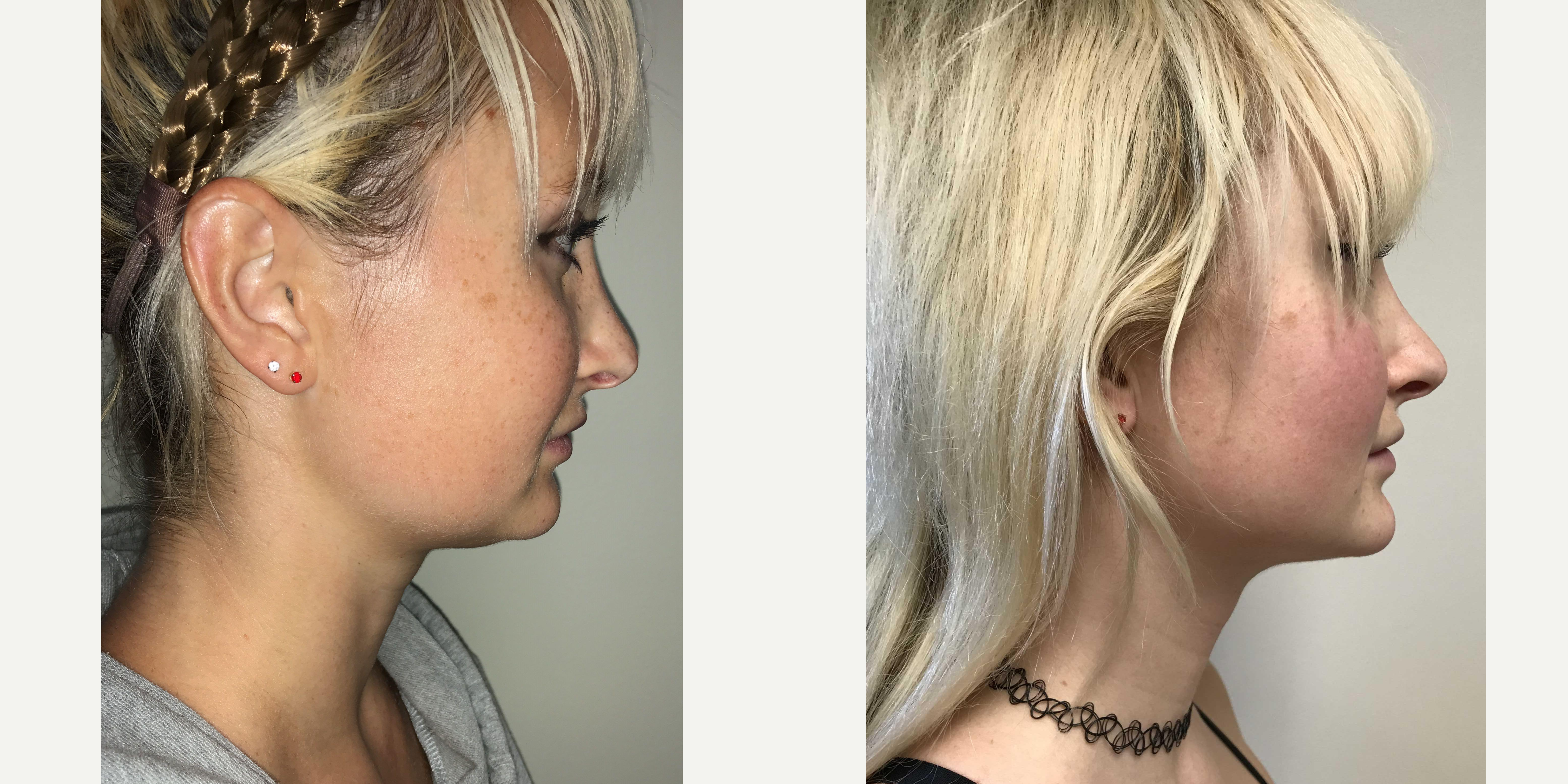 Liposuction before and after photo