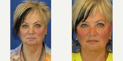 Neck Lift before and after photo