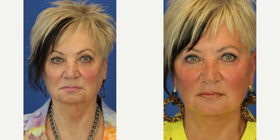 Neck Lift before and after photo