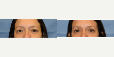 Eyelid Surgery before and after photo