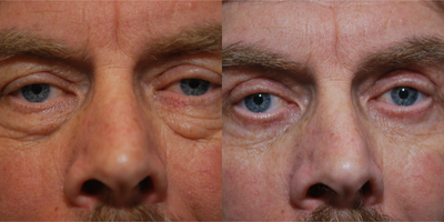 Eyelid Surgery before and after photo
