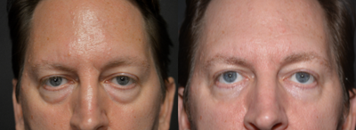 Eyelid Surgery before and after photo