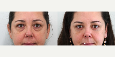 Eyelid Surgery before and after photo
