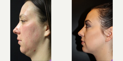 Kybella before and after photo
