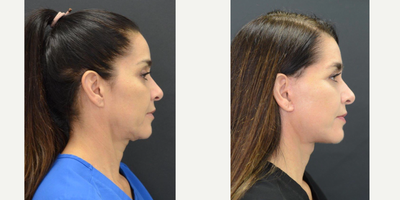 Neck Lift before and after photo