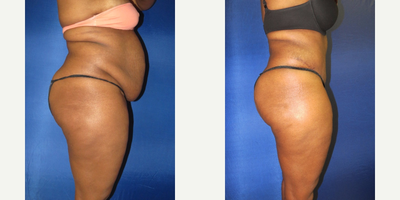 Tummy Tuck before and after photo