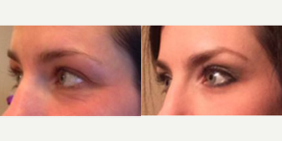 Eyelid Surgery before and after photo