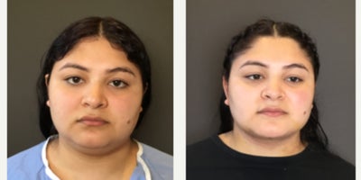 Liposuction before and after photo