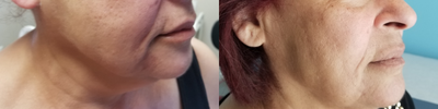 Microneedling before and after photo