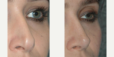 Revision Rhinoplasty before and after photo