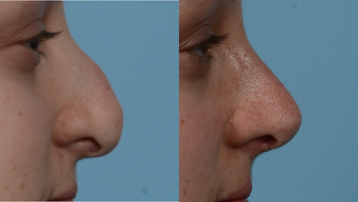 Rhinoplasty before and after photo