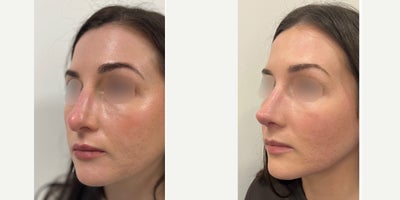 Rhinoplasty before and after photo