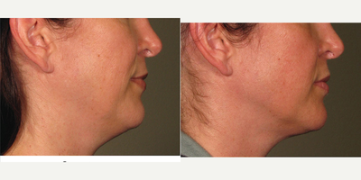 Ultherapy before and after photo