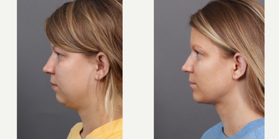 Chin Implant before and after photo
