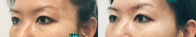 Eyelid Surgery before and after photo