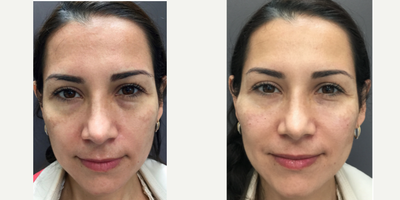 Juvederm before and after photo