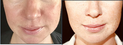 Lip Implants before and after photo