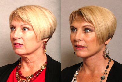 Lower Facelift before and after photo