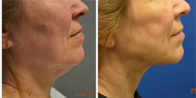 Neck Lift before and after photo