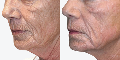 Venus Legacy before and after photo
