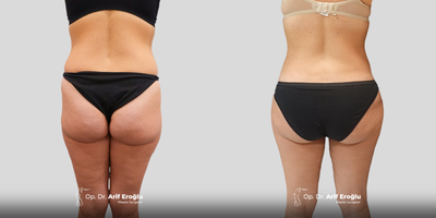Brazilian Butt Lift before and after photo