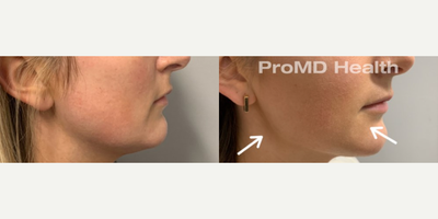 Chin Filler before and after photo