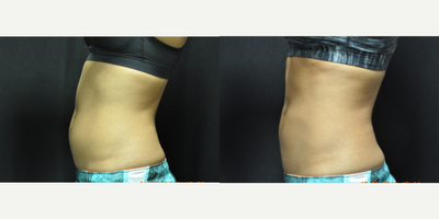 CoolSculpting before and after photo