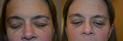 Eyelid Surgery before and after photo