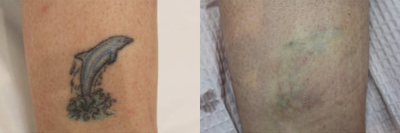 PicoWay before and after photo