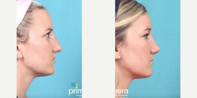 Revision Rhinoplasty before and after photo