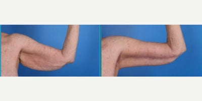 Arm Lift before and after photo