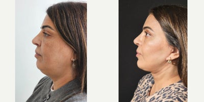 Chin Liposuction before and after photo