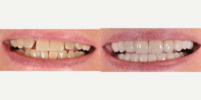 Dental Crown before and after photo