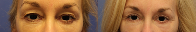 Eyelid Surgery before and after photo