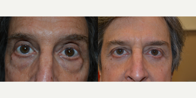 Eyelid Surgery before and after photo