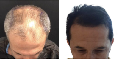 Hair Transplant before and after photo