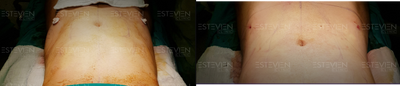 Liposuction before and after photo