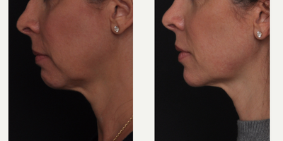 Liquid Facelift before and after photo