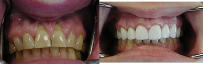 Smile Makeover before and after photo