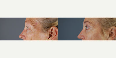 Eyelid Surgery before and after photo