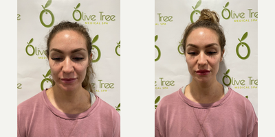 Restylane Silk before and after photo