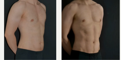 Liposculpture before and after photo