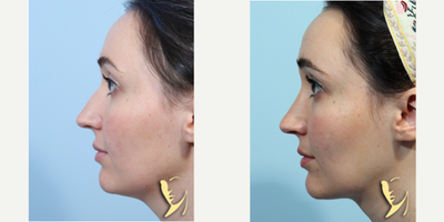 Neck Lift before and after photo