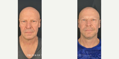 Neck Lift before and after photo