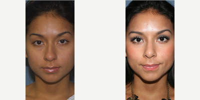 Rhinoplasty before and after photo