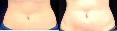 SculpSure before and after photo