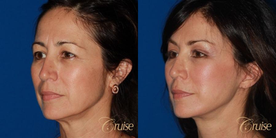 Facelift before and after photo