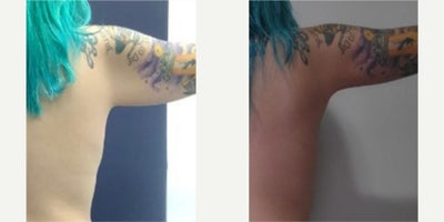 Facelift before and after photo