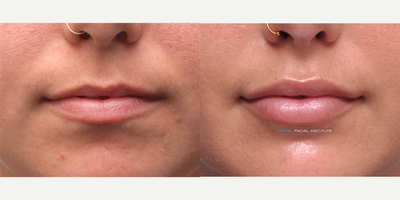 Lip Fillers before and after photo