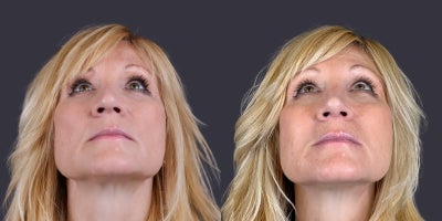 before and after image
